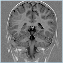 MRI Coronal Image