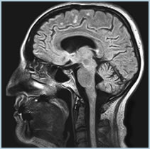 MRI Sagittal Image